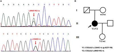 A novel compound heterozygous mutation of COL6A3 in Chinese patients with isolated cervical dystonia